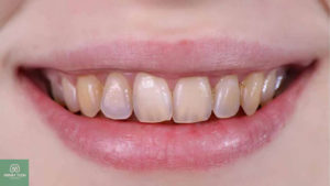 uong ca phe co bi den rang khong uong ca phe co bi den rang khong